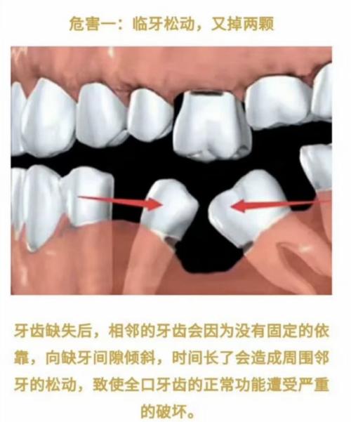 缺一颗牙就必须种一颗吗？种植牙是缺牙修复的唯一选择吗？有哪些利弊和注意事项需提前了解？-图3