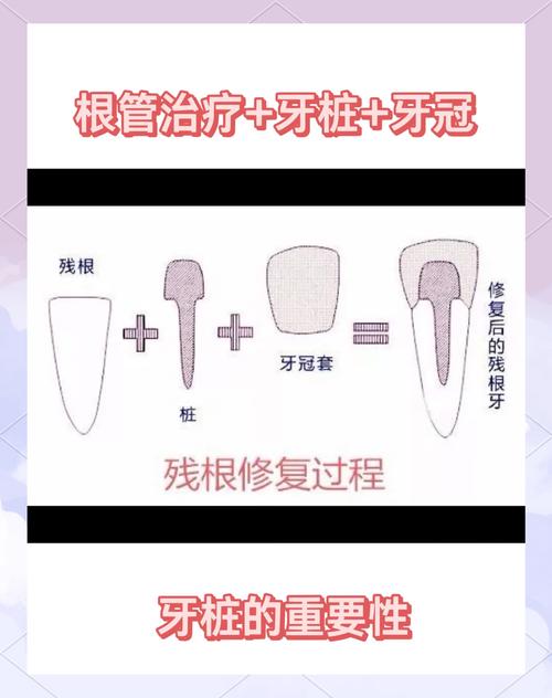 种一个桩安两颗牙可行吗？一个种植体如何支撑两颗牙齿，这种修复方式的安全性与适用条件是什么？-图1