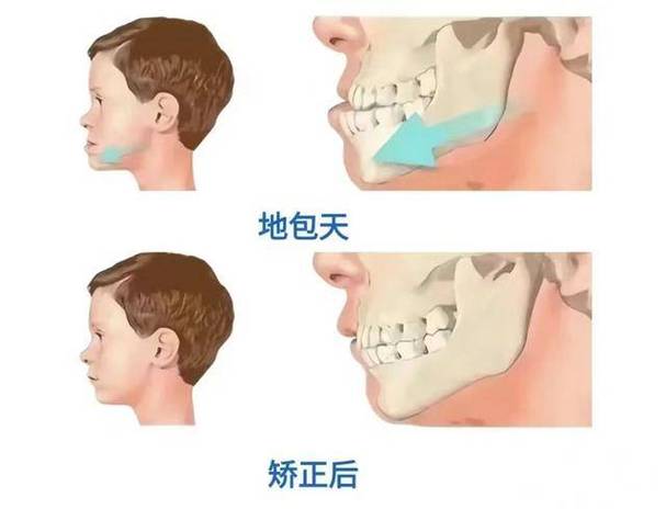 牙槽骨突出矫正方法有哪些？不同年龄段患者如何选择最适合自己的治疗方案？-图3