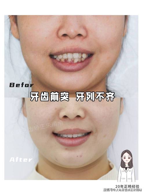 牙齿前突正畸真实案例，矫正后脸型变化明显吗？过程中有哪些关键步骤和注意事项？-图1