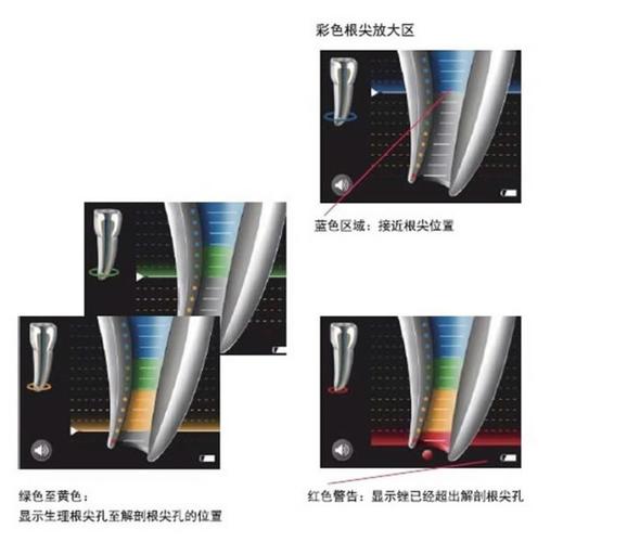 根管测量仪的正确使用方法包含哪些关键步骤？操作中如何避免常见误差确保测量精准？-图1