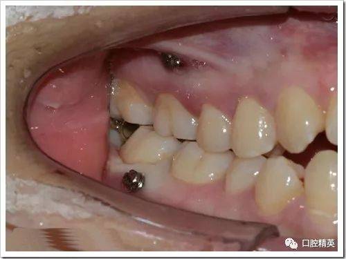 正畸微种植钉植入图片中，操作步骤、解剖结构识别与关键技术要点如何通过影像呈现？-图2