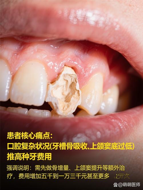 种一颗牙为何动辄上万？价格背后的技术成本与患者负担引热议，到底值不值？-图3