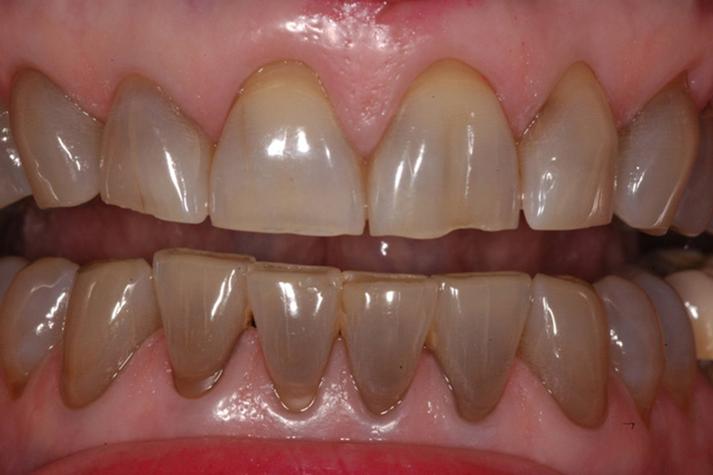 种牙后服用四环素会影响种植体骨结合效果或引发不良反应吗？-图3