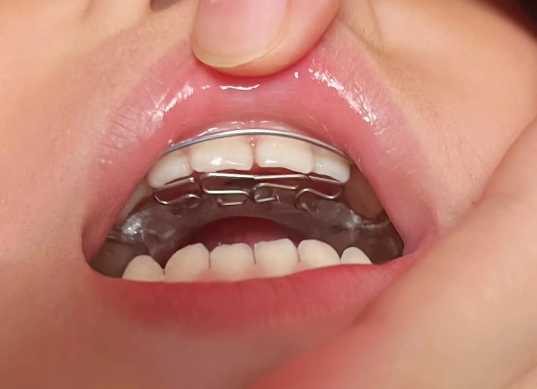 儿童地包天矫正有哪些常见方法？不同年龄段矫正效果有何差异？家长如何选择最适合孩子的矫正方式？-图2