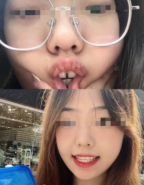 正畸半年门牙缝变得特别大，是什么原因导致的？会影响最终矫正效果吗？-图2