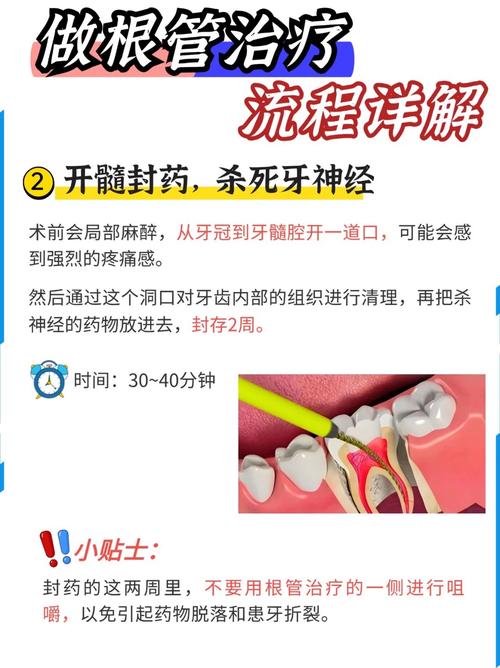 急性牙髓炎有哪些治疗方法?保牙治疗与根管治疗如何选择?不同病情阶段的治疗方案有何差异?-图2 急性牙髓炎有哪些治疗方法?保牙治疗与根管治疗如何选择?不同病情阶段的治疗方案有何差异?-图2