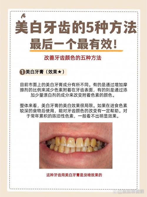 牙齿美白的方法有哪些？不同方式的效果、安全性和适用人群如何科学选择？-图3