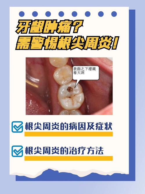 牙根周炎的治疗方法有哪些？不同严重程度下如何选择非手术与手术治疗，日常护理又该注意什么？-图2
