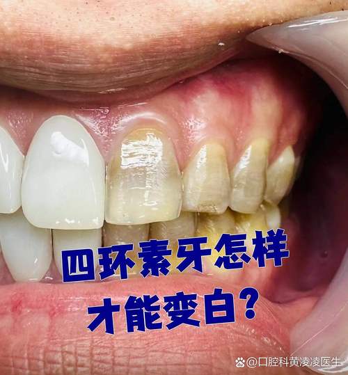 四环素牙颜色深、传统美白效果差，究竟哪些方法能真正安全有效改善？-图2