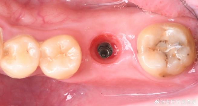 种牙后根充不到位为何会增加种植失败风险?如何通过影像学检查及时发现并处理?-图2 种牙后根充不到位为何会增加种植失败风险?如何通过影像学检查及时发现并处理?-图2