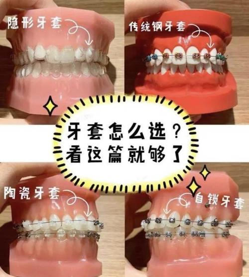 牙套有哪三种常见材料？不同材料各自的特点、适用情况及优缺点该如何区分选择呢？-图2
