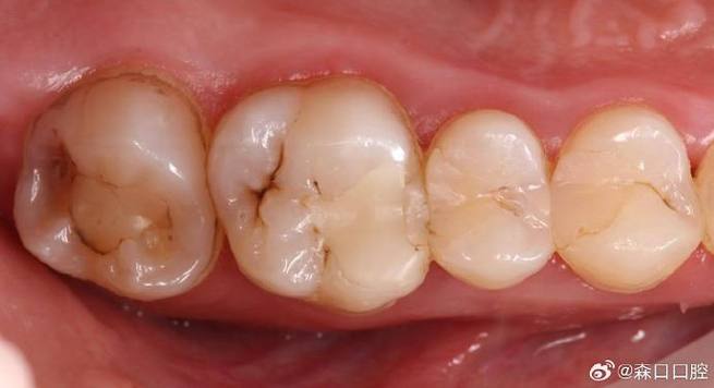 二类洞充填有哪些常用方法？不同充填材料的适用性及操作规范是什么？-图2