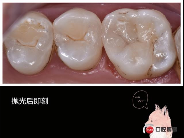 二类洞充填有哪些常用方法？不同充填材料的适用性及操作规范是什么？-图3