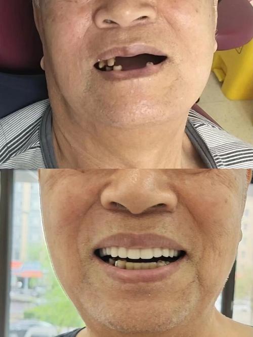 在辽宁省丹东市种牙，大家最关心哪些问题？比如价格多少、哪家医院靠谱、医保怎么报销、种植牙能用多久？-图3