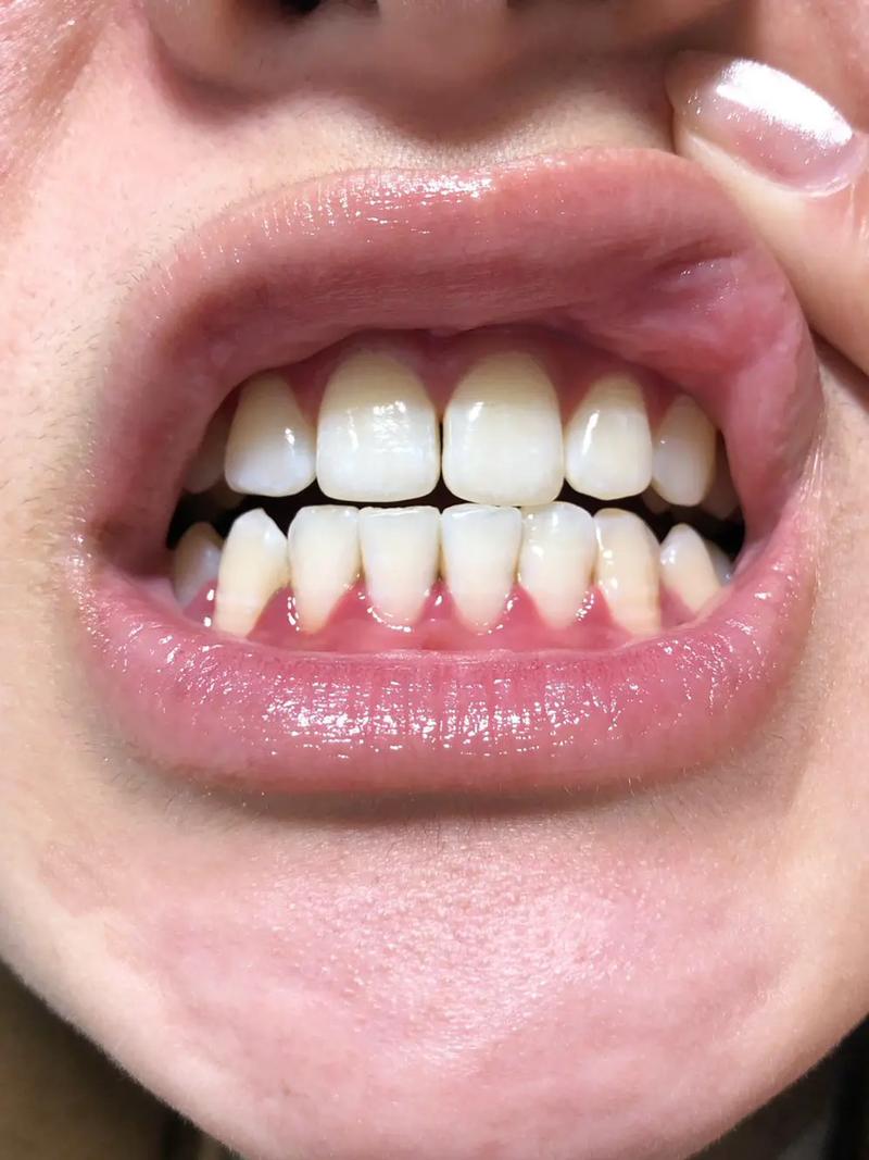 20岁正畸期间牙龈萎缩，是矫正器摩擦还是口腔护理不当导致？会影响牙齿稳固和矫正效果吗？-图3