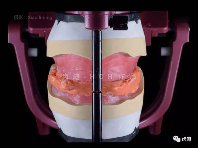 红膏二次印模方法的具体操作步骤是怎样的？如何确保其在口腔修复中的精准适配与稳定性？-图3