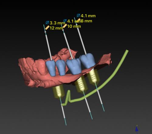 水激光数字化种牙,如何通过精准定位与微创技术,实现种植牙成功率与舒适度的双重突破?-图1 水激光数字化种牙,如何通过精准定位与微创技术,实现种植牙成功率与舒适度的双重突破?-图1
