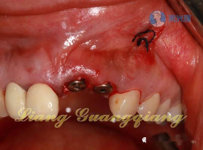 种骨和植牙全过程是怎样的?种骨是植牙的必经步骤吗?两者具体操作步骤、注意事项及术后效果差异有哪些?-图3 种骨和植牙全过程是怎样的?种骨是植牙的必经步骤吗?两者具体操作步骤、注意事项及术后效果差异有哪些?-图3