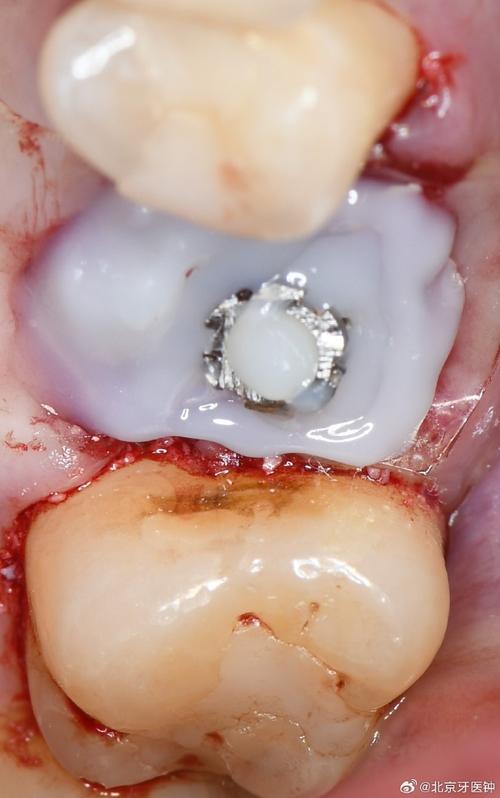 拔牙后2年种植牙-图1 拔牙后2年种植牙-图1