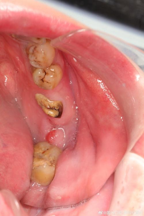 拔牙后2年种植牙-图2 拔牙后2年种植牙-图2