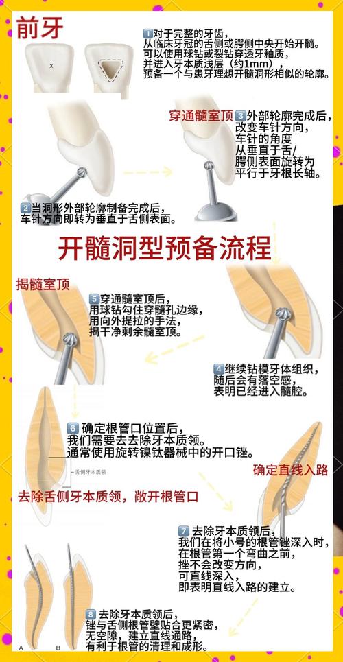 根管钉的使用方法有哪些关键步骤？不同牙体缺损情况下如何正确选择和操作？-图1