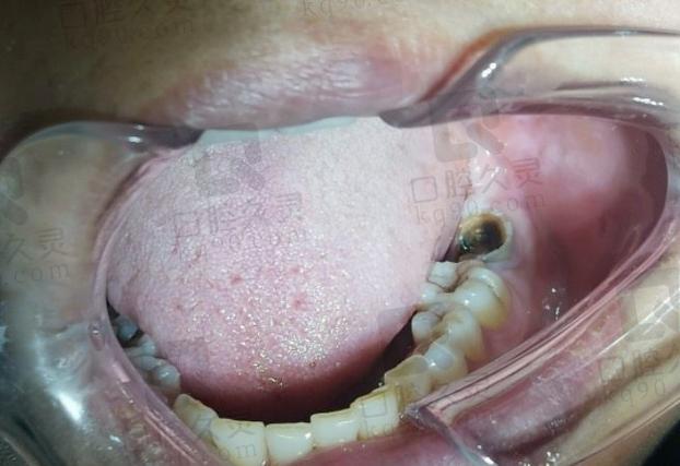 后牙（磨牙）即拔即种真的靠谱吗？需要满足哪些条件？存在哪些潜在风险？-图3