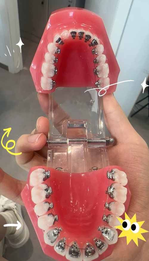 口腔正畸舌侧矫治技术虽美观隐蔽，但操作复杂度高、费用昂贵，其临床效果真的优于传统托槽矫治吗？适合哪些错颌畸形患者？-图2