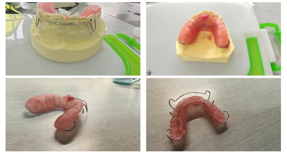 牙合垫主要分为哪两种类型？它们各自的设计原理、适用症状及临床应用场景有何不同？-图1