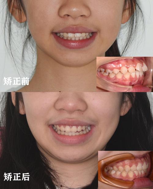 龅牙正颌手术前为何必须进行术前正畸？其具体作用、时长及对手术效果和术后恢复的关键影响是什么？-图1