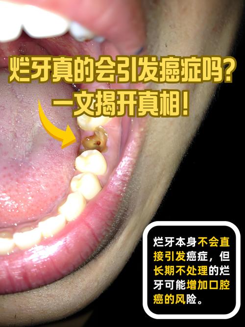 正畸治疗真的会导致牙齿坏死吗？牙根吸收、牙髓坏死的风险究竟有多大？-图2