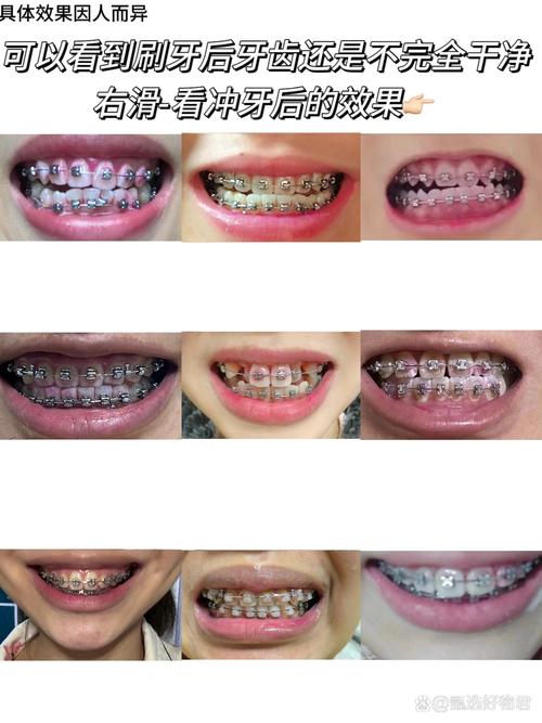 正畸治疗真的会导致牙齿坏死吗？牙根吸收、牙髓坏死的风险究竟有多大？-图3