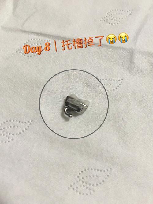 牙齿正畸时托槽突然掉了是什么原因导致的？需要马上处理吗？会不会影响最终的矫正效果？-图2
