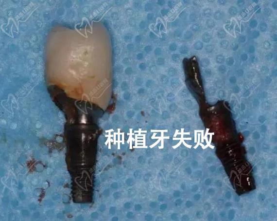 种牙一段式失败率为何居高不下？背后隐藏哪些技术风险与术后隐患？-图3