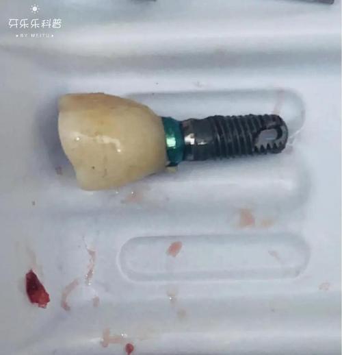 种牙一段式失败率为何居高不下？背后隐藏哪些技术风险与术后隐患？-图1