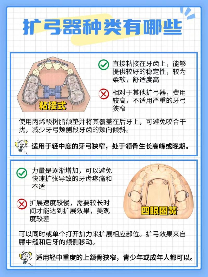 成年人骨骼已定型,扩弓真的可行吗?具体方法有哪些?效果和风险如何?-图1 成年人骨骼已定型,扩弓真的可行吗?具体方法有哪些?效果和风险如何?-图1