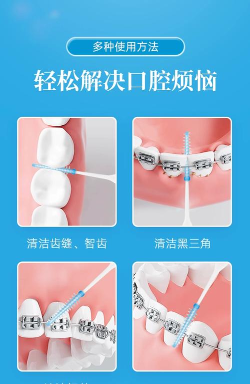 间齿刷的正确使用方法是什么?新手必看的清洁步骤、适用频率及注意事项全解析-图1 间齿刷的正确使用方法是什么?新手必看的清洁步骤、适用频率及注意事项全解析-图1