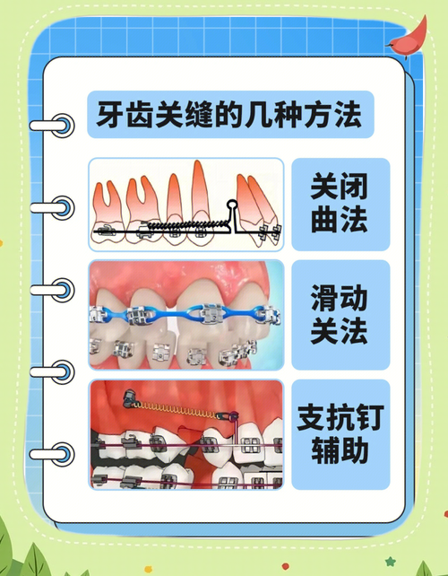 正畸内收牙齿究竟需要多少牙缝？牙缝数量与内收效果、矫正周期有何关联？-图2