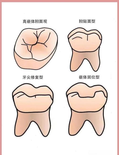 牙嵌体究竟属于哪种牙科修复体类型？与传统充填体、全冠等修复方式有何本质区别？-图2
