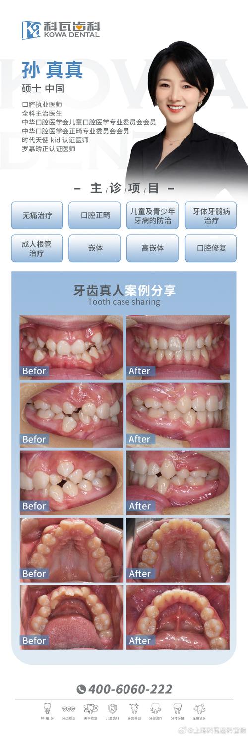 正畸模型拥挤度测量方法有哪些？不同测量方法的准确性如何影响正畸治疗方案的制定？-图3