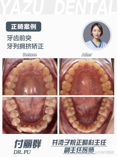 正畸模型拥挤度测量方法有哪些？不同测量方法的准确性如何影响正畸治疗方案的制定？-图1