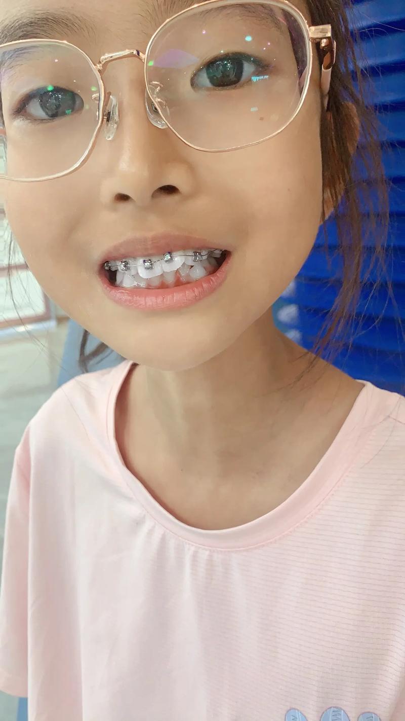 十岁女孩处于生长发育期，种植牙是否可行？需满足哪些条件？会不会影响颌骨正常发育？-图1