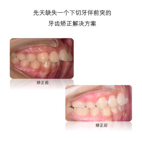 侧切牙有蛀牙/龋坏还能做正畸吗?烂牙未治好会影响矫正效果或导致牙齿健康问题吗?-图2 侧切牙有蛀牙/龋坏还能做正畸吗?烂牙未治好会影响矫正效果或导致牙齿健康问题吗?-图2