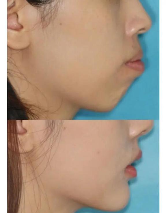 上颌窦区域牙齿存在问题时，正畸治疗可行吗？有哪些风险和注意事项？-图2