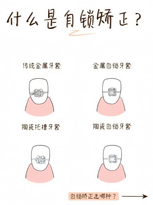 针对不同类型的牙齿锁合,如何科学判断并选择真正适合自己的最佳矫正方案?-图1 针对不同类型的牙齿锁合,如何科学判断并选择真正适合自己的最佳矫正方案?-图1