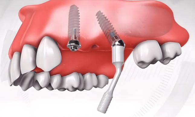 种牙植骨的全过程包含哪些关键步骤？术前评估、植骨手术到最终戴牙，每个阶段有哪些注意事项和风险？-图1