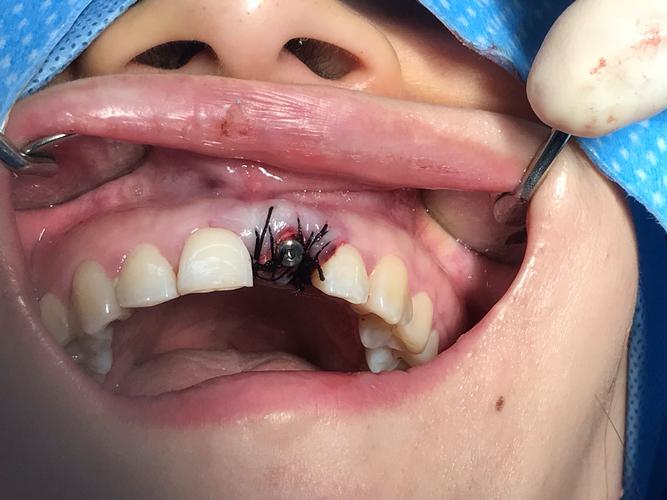 种牙植骨的全过程包含哪些关键步骤?术前评估、植骨手术到最终戴牙,每个阶段有哪些注意事项和风险?-图3 种牙植骨的全过程包含哪些关键步骤?术前评估、植骨手术到最终戴牙,每个阶段有哪些注意事项和风险?-图3