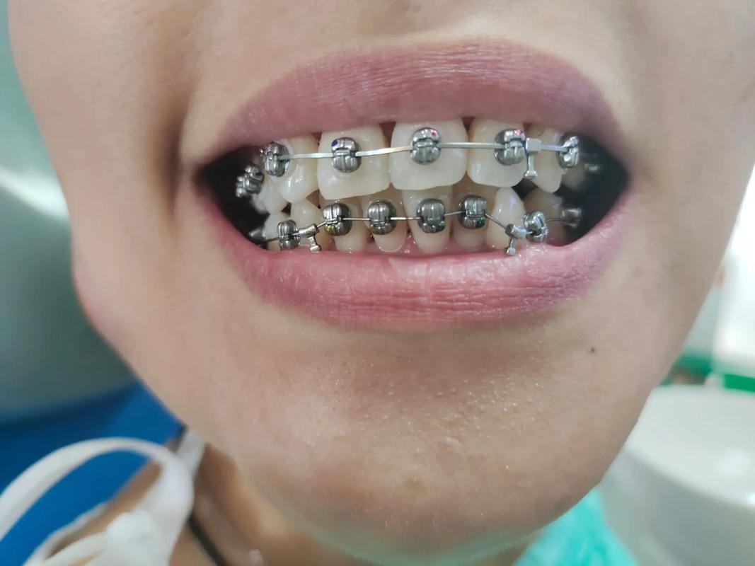 正畸矫正时给牙齿上托槽一般需要多久？单次操作耗时多久？不同牙齿拥挤程度会影响上托槽时间吗？-图1