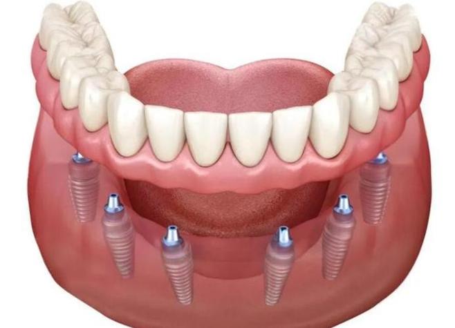 一次种6颗种植牙真的安全吗?需要满足哪些牙槽骨条件?手术风险和术后恢复期会如何?-图1 一次种6颗种植牙真的安全吗?需要满足哪些牙槽骨条件?手术风险和术后恢复期会如何?-图1