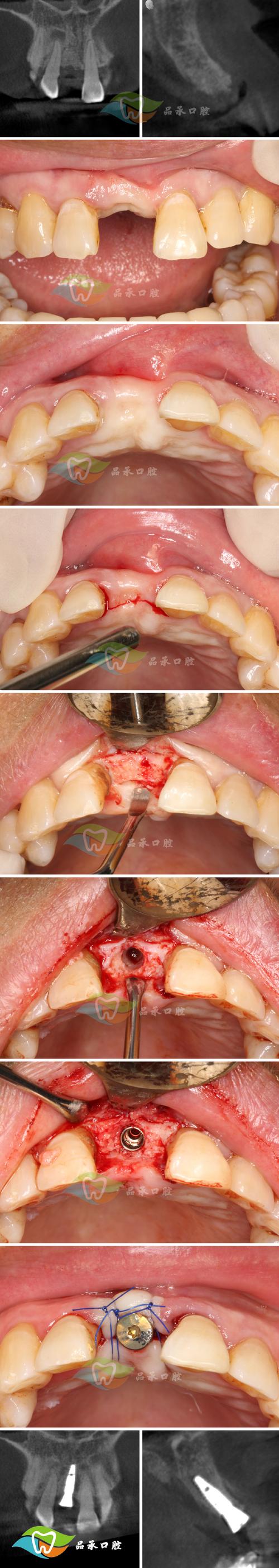 植骨后到底多久才能开始正畸？骨愈合周期、骨质条件会影响矫正时机吗？-图2